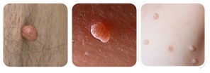 skin tags