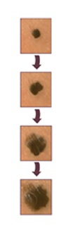 Changing mole size, shape or color